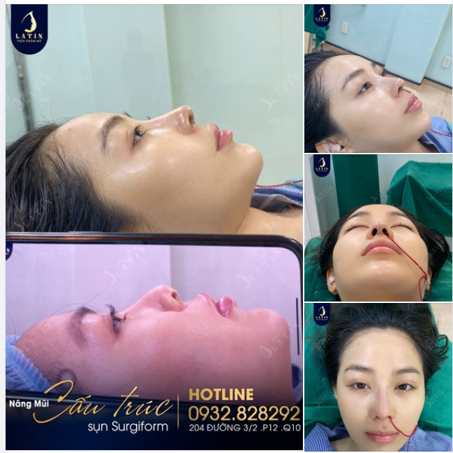 Mời cả nhà cùng xem kết quả sau khi thực hiện nâng mũi cấu trúc surgiform của em: