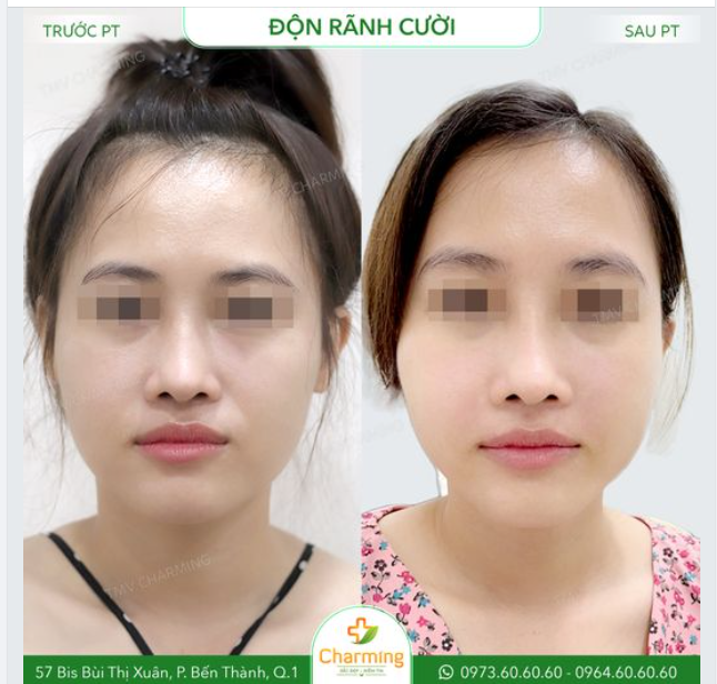 Để tạm biệt chiếc rãnh mũi má ấy bạn có thể chọn một trong ba phương pháp: độn rãnh mũi má, tiêm Filler hoặc cấy mỡ tự thân. Và đây là bạn khách đã chọn độn rãnh mũi má.