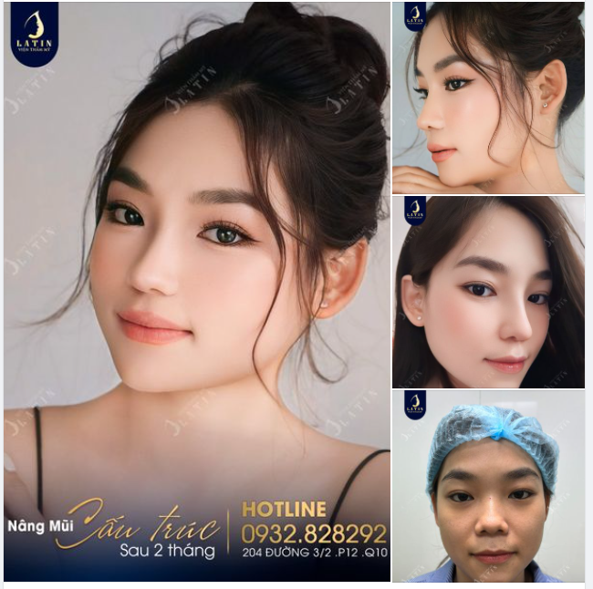 Feedback: Khuôn mặt tươi sáng, rạng ngời sau 2 tháng nâng mũi cấu trúc tại Latin