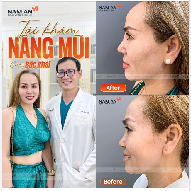 Tái khám sau 1 tháng nâng mũi cấu trúc cùng GĐCM - BS CK1 Đỗ Quang Khải