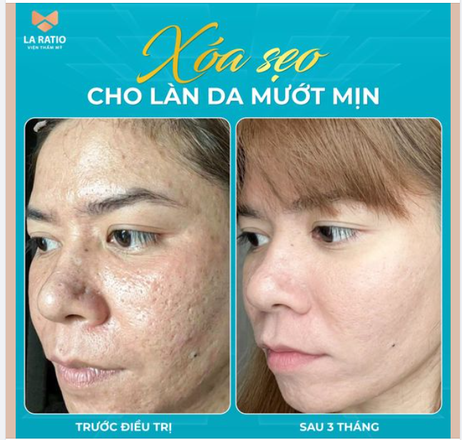 TRƯỚC TỰ TI VÌ MỤN GIỜ TỰ TI VÌ SẸO MỤN