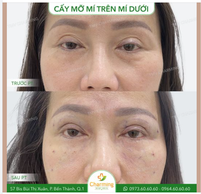 Nhìn chiếc mí khổng lồ thế này thì ai cũng nghĩ vị khách này nên cắt mí để khắc phục tình trạng của đôi mắt.