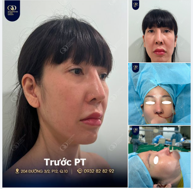 Combo Nâng cung mày + Mũi tái cấu trúc cho chị gái A.G