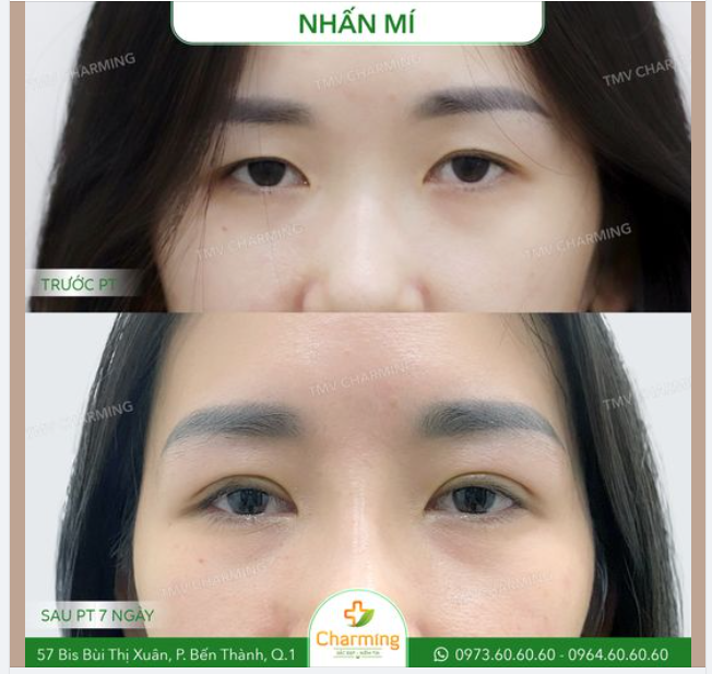 Giải pháp muôn thuở cho những đôi mắt trẻ trung nhưng lại một mí hoặc mắt hai mí nhưng 1 ít da thừa lấn chiếm mí trên đó là: NHẤN MÍ.