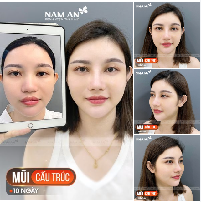 MŨI ĐẸP THANH THOÁT SAU 14 NGÀY