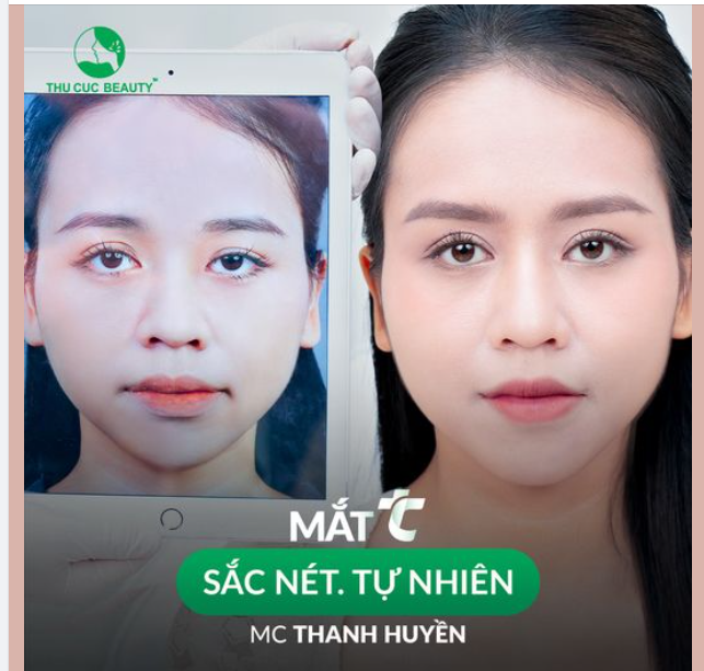 Từ nay MC Thanh Huyền đã vô cùng tự tin vì có nếp mí to tròn rồi