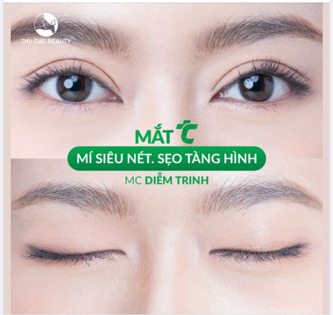 Cắt mí siêu nét, đường sẹo tàng hình chỉ có tại Thu Cúc