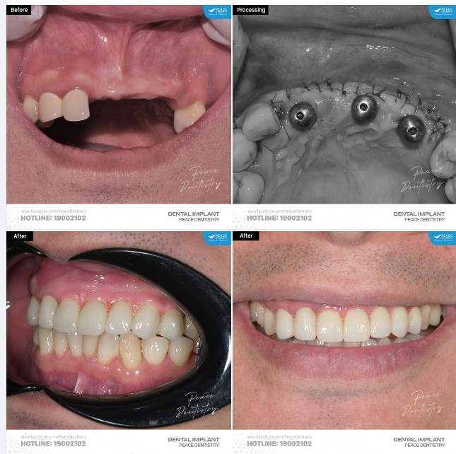TRỒNG RĂNG IMPLANT LÀ SỰ ĐẦU TƯ BỀN VỮNG CHO SỨC KHOẺ