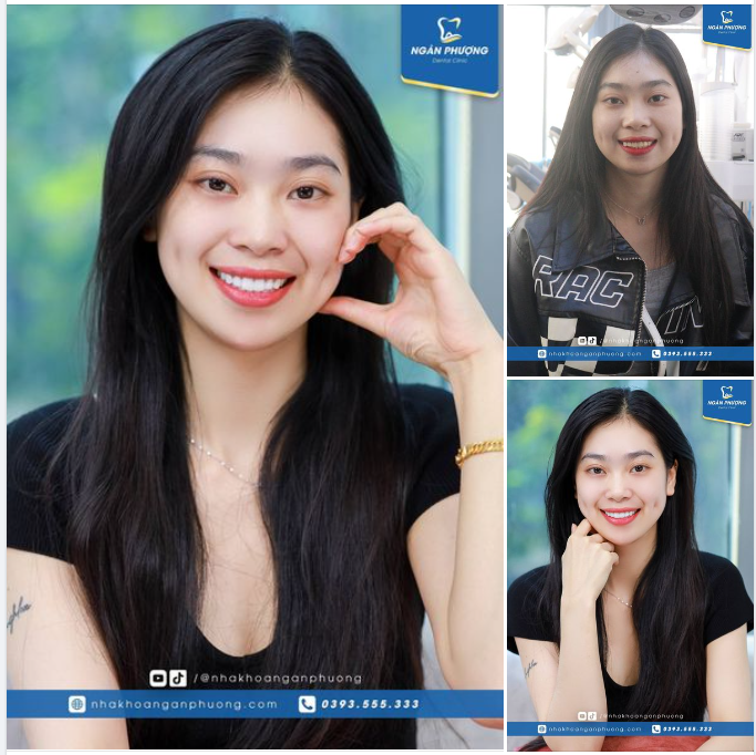 Rạng rỡ nụ cười của Nguyễn Trang với răng sứ mới