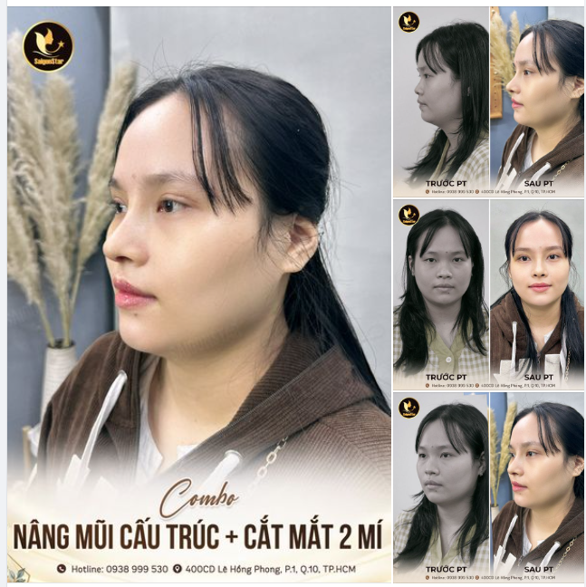 KH. A MỊ THÀNH CÔNG NÂNG HẠNG THẦN THÁI SAU 10 NGÀY NÂNG MŨI CẤU TRÚC + CẮT MẮT 2 MÍ