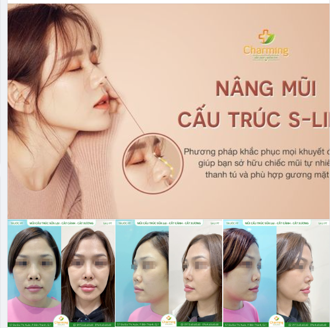 NÂNG MŨI CẤU TRÚC - LỰA CHỌN TỐI ƯU CHO CHIẾC MŨI GỌN GÀNG MÀ LẠI TỰ NHIÊN