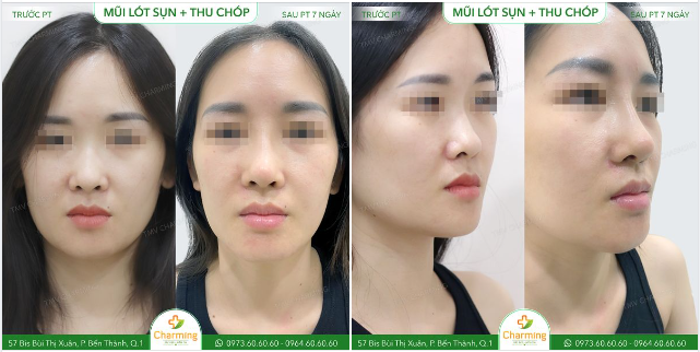 Trong hai tấm ảnh bên dưới thì ngoài màu son ra, chiếc mũi của bạn cũng là một sự thay đổi đáng chú ý đấy