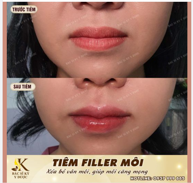 Tạo hình môi bằng Filler  - Giúp đôi môi căng mọng.  - Tạo hình môi theo ý muốn.  - Nhẹ nhàng, đơn giản.  - Sử dụng Filler chính hãng.