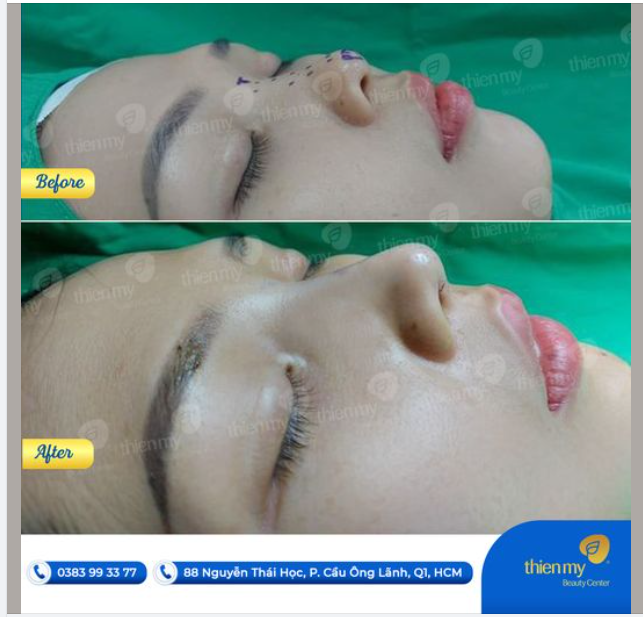 Dáng mũi siêu tự nhiê tại PKCK Thiện Mỹ 