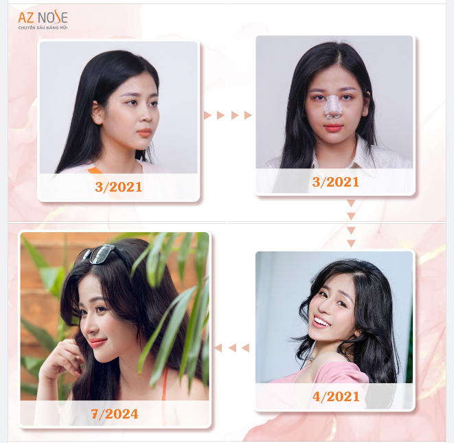 Xinh tự nhiên sau 3năm nâng mũi cấu trúc