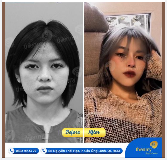 Mỗi một khách hàng đến nâng mũi tại PKCK Thiện Mỹ luôn chứa đựng những câu chuyện riêng