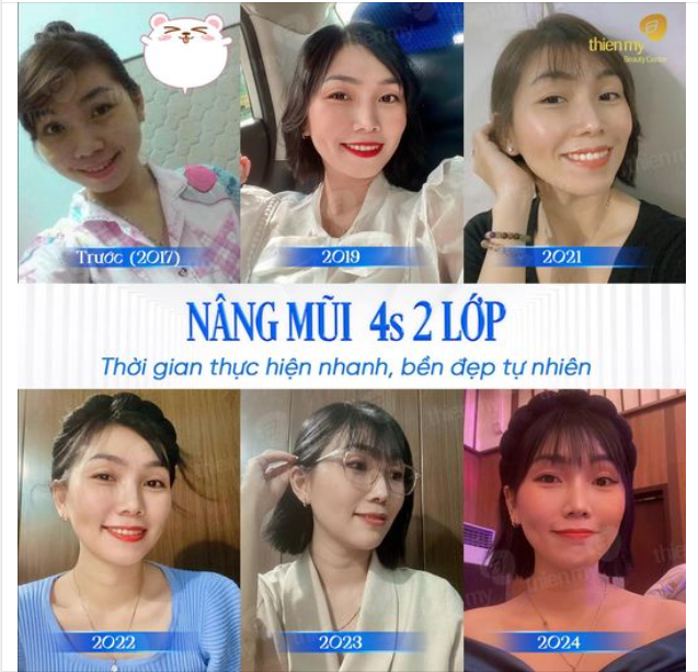Nhan sắc thăng hạng nhờ thay đổi dáng mũi tại PKCK Thiện Mỹ. Cùng nhìn lại sự thay đổi của chị khách hàng sau khi nâng mũi