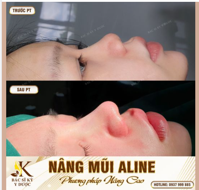 "ĐỘ" DÁNG MŨI MỚI ĐỂ XINH ĐẸP VÀ TỰ TIN HƠN