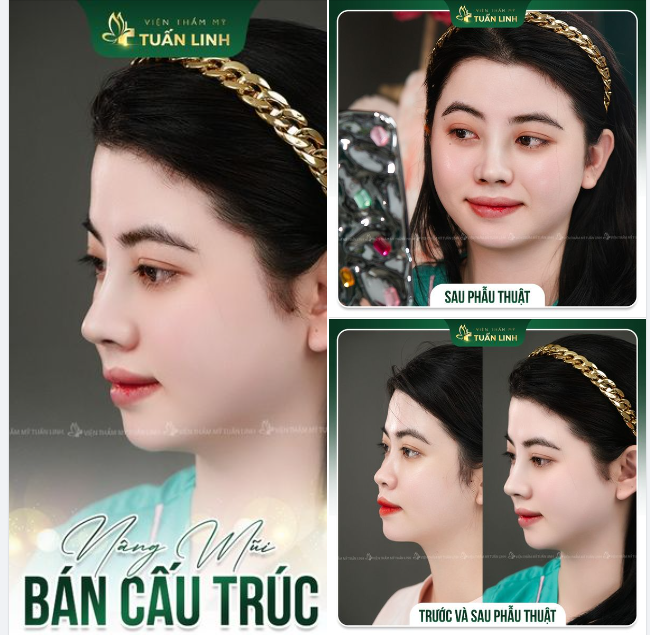 XINH ĐẸP SẮC NÉT CUỐN HÚT HƠN SAU NÂNG MŨI!!