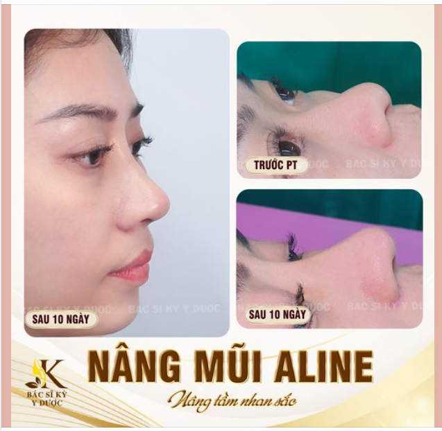 THAY ĐỔI DÁNG MŨI - TỎA SÁNG TỰ NHIÊN