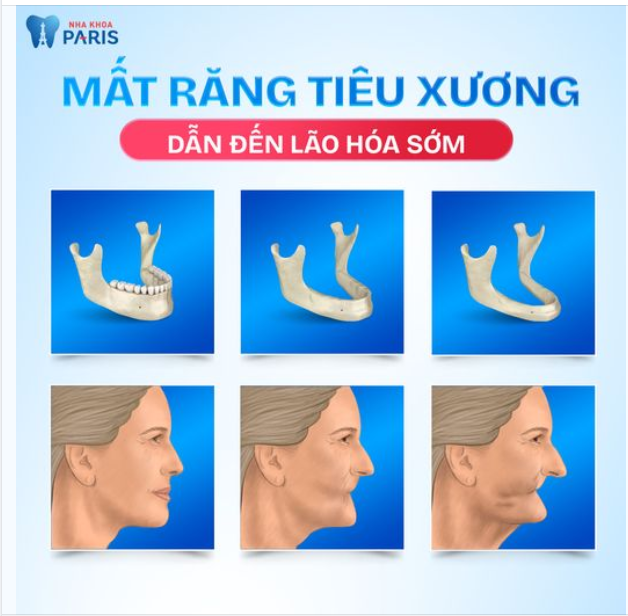 ĐÂY LÀ LÝ DO TẠI SAO CHÚNG TA NỀN TRỒNG RĂNG IMPLANT SỚM!