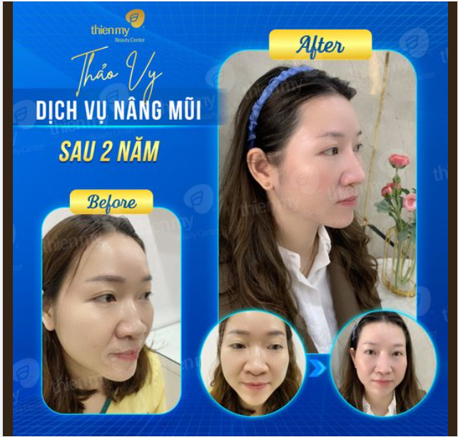 Từ ngày chị Thảo Vy tin tưởng lựa chọn PKCK Thiện Mỹ để nâng mũi, đã tròn 1 năm.