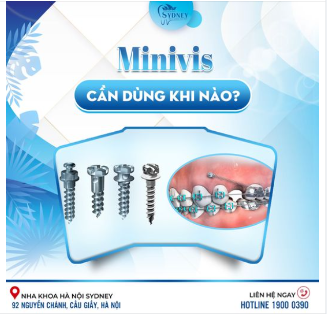 MINIVIS CẦN DÙNG KHI NÀO?