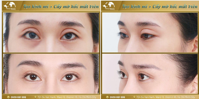 Khách hàng tìm đến Thế Giới Đẹp trong tình trạng Mí mắt đã qua 4 lần ph.ẫu thuật không vừa ý tại Spa với nhiều khuyết điểm: