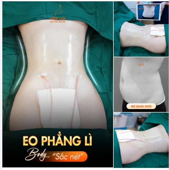 Hô biến "mỡ bụng dưới" thành vòng "eo phẳng lì" chỉ sau 90 phút