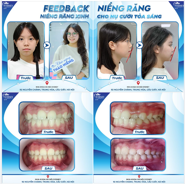 NIỀNG RĂNG XINH CHO NỤ CƯỜI TỎA SÁNG