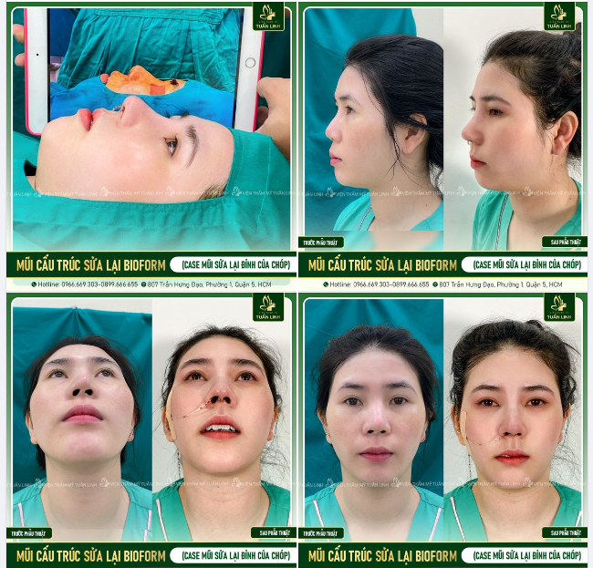 Nâng mũi sửa lại luôn là một case mũi khó - Đòi hỏi kỹ năng cũng như tay nghề và kinh nghiệm nhiều năm từ ekip bác sĩ nhà Tuấn Linh: