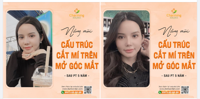 Bên cạnh nâng mũi, nàng còn mở góc mắt và cắt mí trên để giúp đôi mắt thêm phần rạng ngời, thu hút nữa đó nha