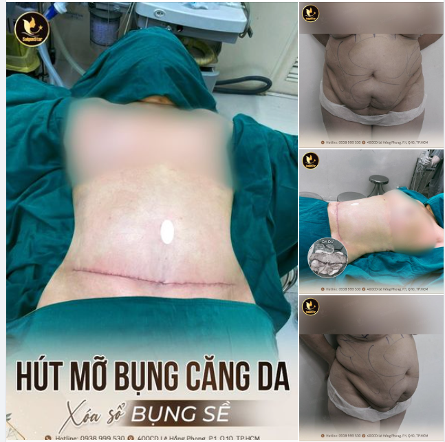 90 PHÚT HỒI "HỒI SINH" VÓC DÁNG - THÀNH CÔNG GIÚP MẸ BỈM SỮA XÓA SỔ BỤNG SỀ