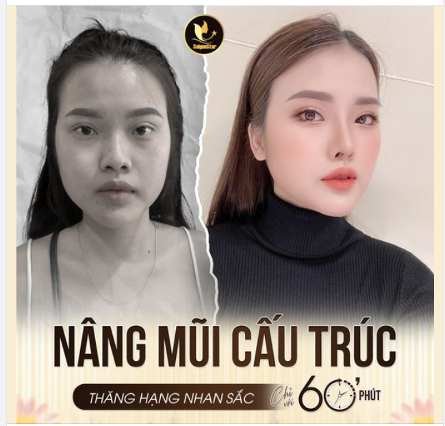 NÂNG MŨI CẤU TRÚC - THĂNG HẠN THẦN THÁI