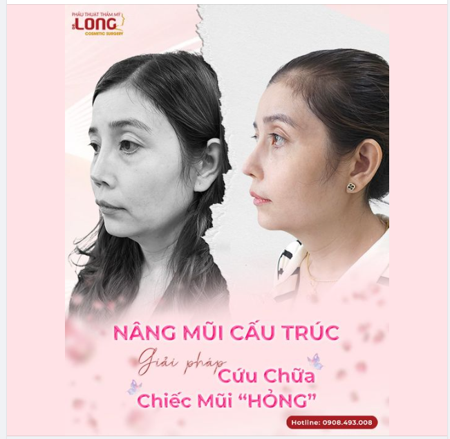 MŨI HỎNG ĐÃ SỬA LẠI NHIỀU LẦN SẼ LÀ CẢM GIÁC NHƯ THẾ NÀO?