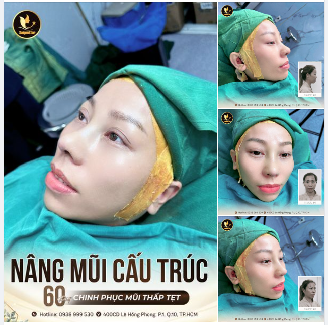 KIỂM CHỨNG NGAY DÁNG MŨI CẤU TRÚC SAU 60 PHÚT THỰC HIỆN