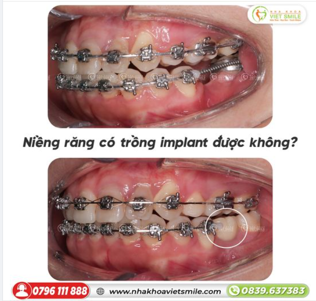 NIỀNG RĂNG CÓ TRỒNG IMPLANT ĐƯỢC KHÔNG?