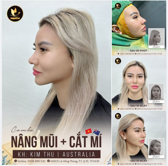 CHUYÊN MỤC ĐẾN HẸN LẠI KHOE - NÂNG MŨI + CẮT MÍ SAU 10 NGÀY SẼ LÀ DIỆN MẠO THẾ NÀO?
