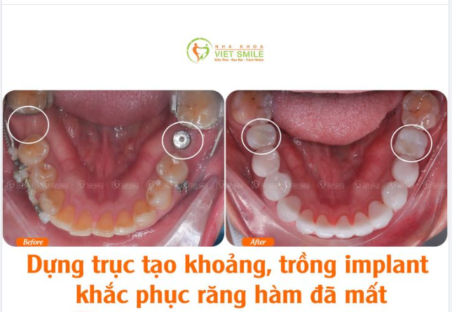 DỰNG TRỤC TẠO KHOẢNG, TRỒNG IMPLANT KHẮC PHỤC RĂNG HÀM ĐÃ MẤT