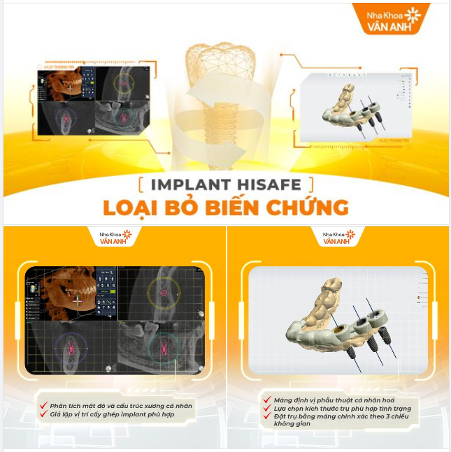 TRỒNG RĂNG IMPLANT CÔNG NGHỆ HISAFE - LOẠI BỎ BIẾN CHỨNG