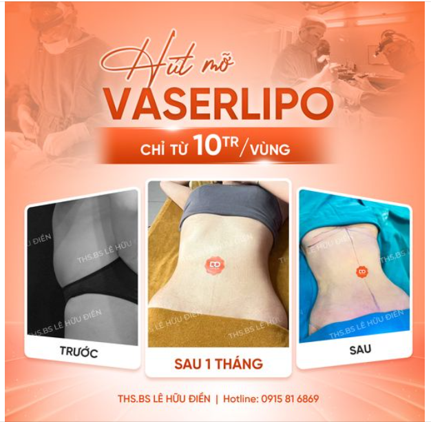 Người thật, kết quả thật Show cho cả nhà cùng chiêm ngưỡng sự thay đổi của khách hàng sau 1 tháng Hút mỡ Vaser Lipo.