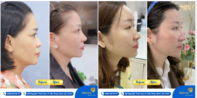 Minh chứng PKCK Thiện Mỹ luôn làm đẹp từ tâm, kiến tạo dáng mũi đẹp tự nhiên là đây....
