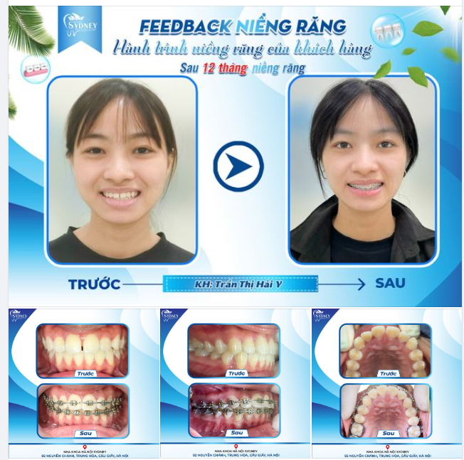 HÀNH TRÌNH NIỀNG RĂNG CỦA KH. HẢI YẾN