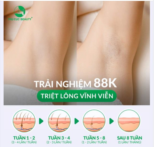 Tạm biệt viêm lỗ chân lông, lông mọc ngược, mùi cơ thể... chỉ với 1 lần triệt