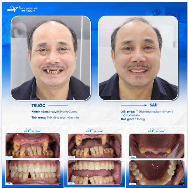 VIỆT KIỀU ĐỨC LỰA TRỌN NHA KHOA LẠC VIỆT INTECH ĐỂ TRỒNG RĂNG VÌ THẤY BÁC SĨ QUÁ GIỎI