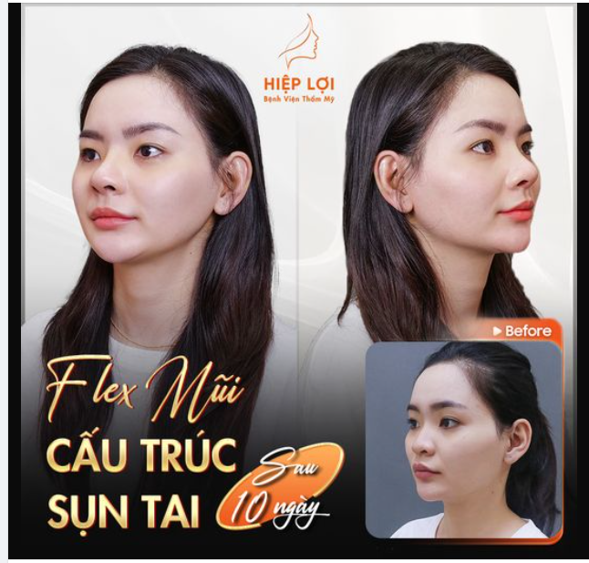 Flex chiếc mũi "cấu trúc sụn tai" chỉ sau 10 ngày