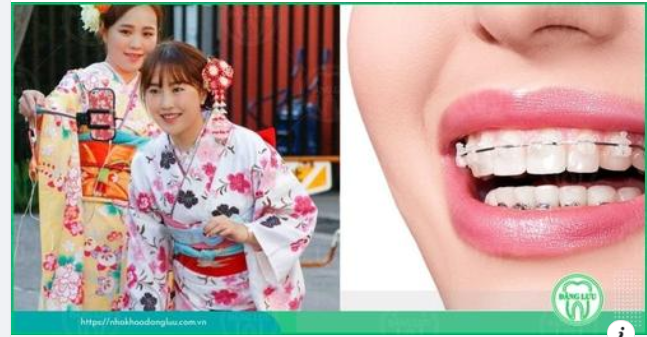 BẬT MÍ: Những thông tin hữu ích khi niềng răng ở Nhật