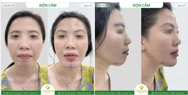 Góc nghiêng gọn gàng chỉ sau phẫu thuật độn cằm, mọi người có tin được không?