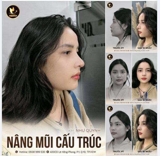 HÓA THÂN THÀNH CÔ NÀNG CÁ TÍNH SAU 10 NGÀY NÂNG MŨI CẤU TRÚC