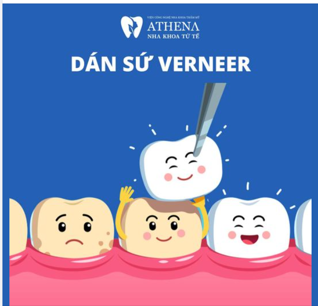 Bạn muốn sở hữu nụ cười hoàn hảo mà không phải tốn quá nhiều thời gian? Dán sứ Veneer là giải pháp lý tưởng giúp bạn có được nụ cười mà mình mong muốn chỉ trong vài buổi điều trị tại Athena.